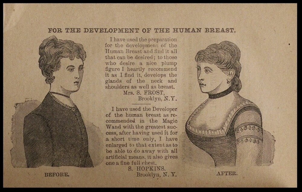 A vintage illustration showing two women, labelled 'Before' and 'After,' highlighting breast development